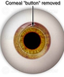 Corneal button removed during pkp