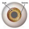 Corneal graft with sutures