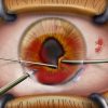 Cornea surgery for eye injury