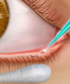 Dry eye syndrome treatment with laser