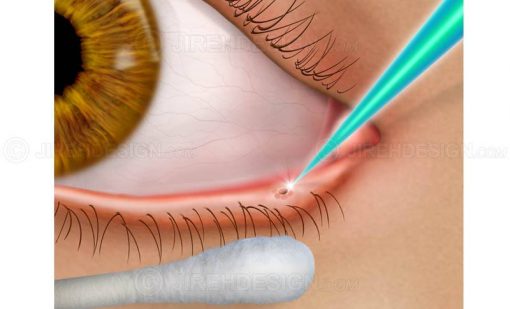 Dry eye syndrome treatment with laser #sude0001