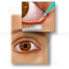 Laser punctal occlusion for dry eye syndrome