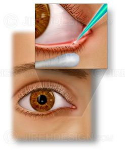 Laser punctal occlusion for dry eye syndrome
