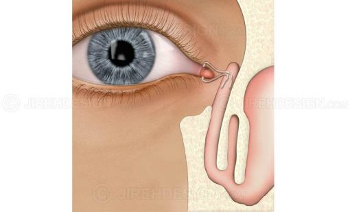 Implants to drain tears