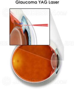 YAG laser for glaucoma
