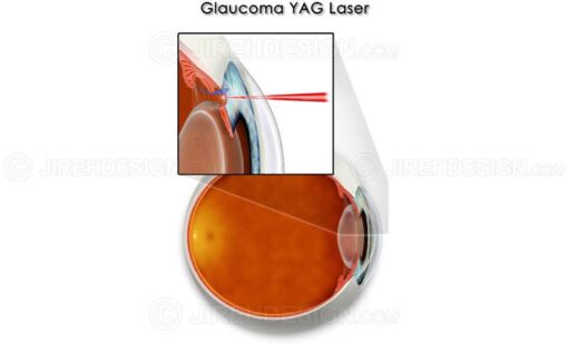 YAG laser for glaucoma