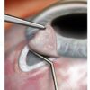 Glaucoma surgery filtering bleb