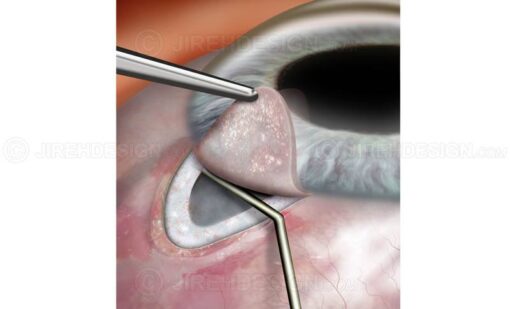 Glaucoma surgery filtering bleb