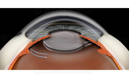 Piggyback IOLs in the eye after cataract surgery #sui0016