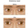 Strabismus repair surgery before and after