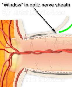 Optic nerve sheath fenestration surgery