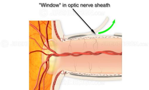 Optic nerve sheath fenestration surgery