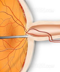 Optic nerve fenestration surgery