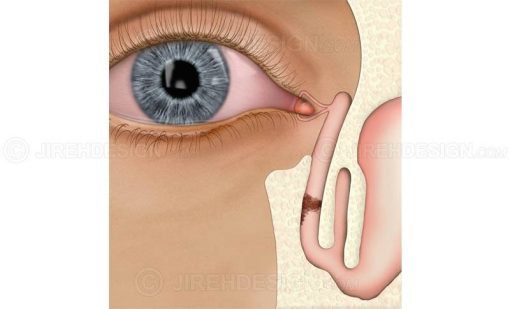 Lacrimal blockage