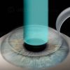 Lasik for nearsighted vision