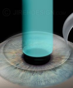 Lasik for nearsighted vision