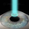 Refractive laser eye surgery for hyperopia and myopia