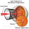 Laser treatment for wet macular degeneration