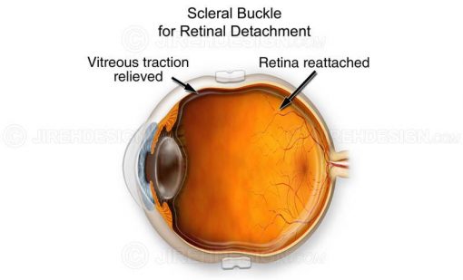 Scleral buckle