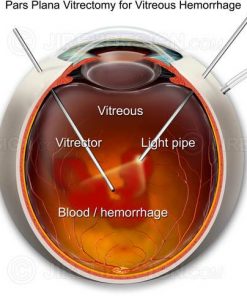Pars plana vitrectomy for vitreous hemorrhage