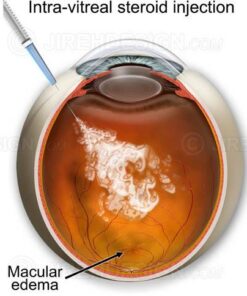 kenalog injection for macular edema