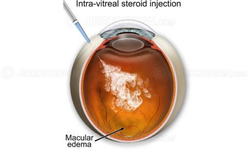 Intra-vitreal steroid injection into the eye #suvr0018