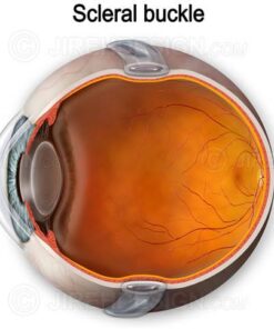 Illustration of scleral buckle around eyeball