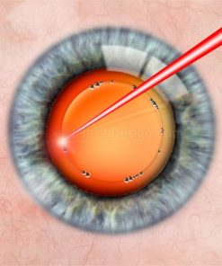 Laser cataract surgery capsulorhexis