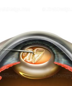 Cataract surgery removing capsular bag opening