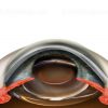Intraocular lens implant in the bag