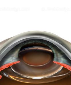 Intraocular lens implant in the bag