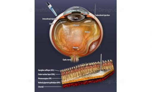 Intraocular drug injection therapies
