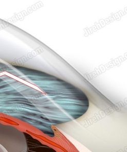 Tunneling clear corneal incision for small incision cataract surgery. A surgical illustration.