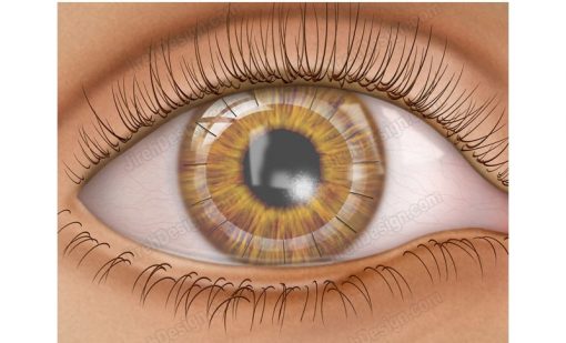 Corneal transplant penetrating keratoplasty and sutures in a post-op surgical illustration.