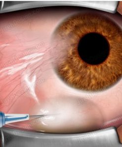 Pterygium removal is done in several steps.