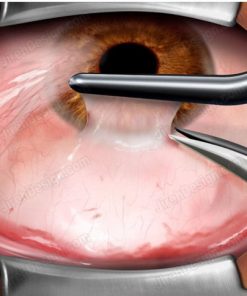 Creating a conjunctival graft in pterygium removal surgery.