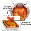 Pars plana vitrectomy for vitreous hemorrhage in diabetes