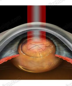 Femtosecond laser cataract surgery lens emulsification