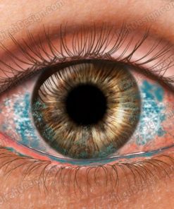 Dry eye with lissamine stain - co0170