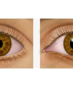 Pupil dilation - ec0010