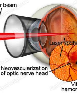 Argon laser photocoagulation for diabetic retinopathy - suvr0006