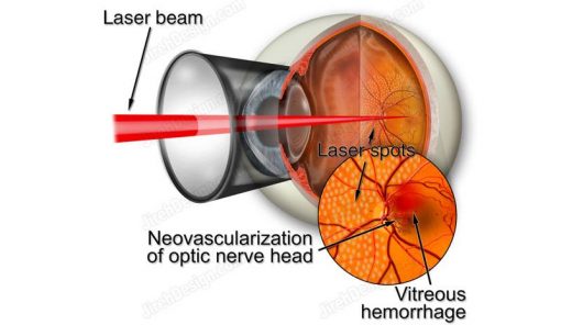 Argon laser photocoagulation for diabetic retinopathy - suvr0006