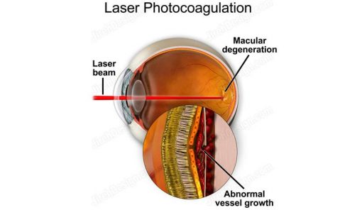 Laser photocoagulation for wet AMD - suvr0010