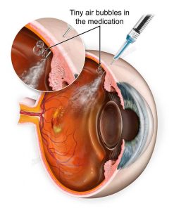 Anti-VEGF eye injection depicting the air bubbles released with the medication - #SUVR0089