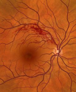 branch retinal vein occlusion brvo