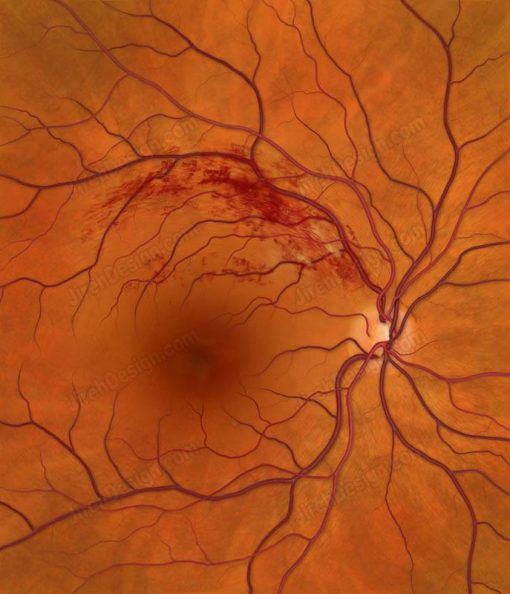 branch retinal vein occlusion brvo