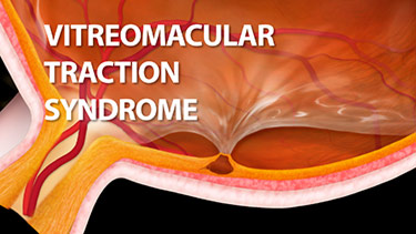 Vitreomacular Traction Syndrome - VMT