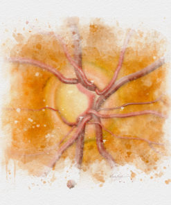 Glaucoma optic nerve watercolor art print