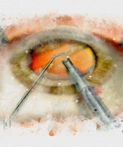 Cataract surgery with phacoemulsification