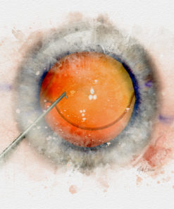 Cataract IOL surgery watercolor style print